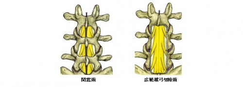 腰痛の原因の1つ『腰部脊柱管狭窄症』の症状・原因・治療方法について誰でも分かるように解説します。 リハビリテーションコンサルタント