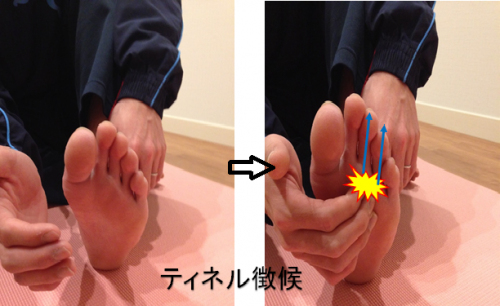 ティネル徴候