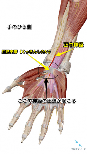 手根管症候群