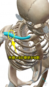鎖骨骨折