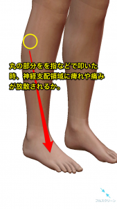 ティネルサイン