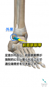 腓骨遠位端骨折