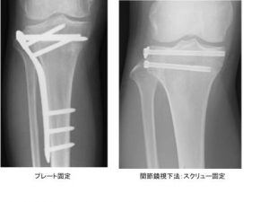 膝の骨折『脛骨高原骨折（脛骨近位端骨折）』の概要と ...